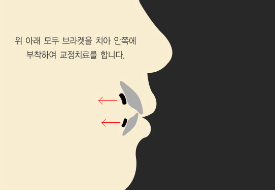 설측교정 모식도